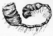 Bilious calculus